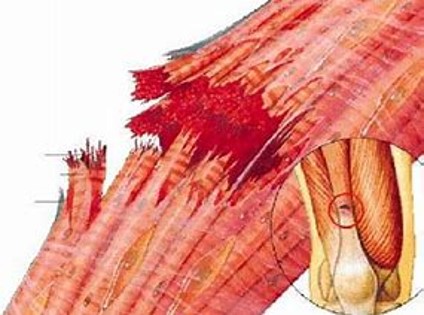 lesión muscular